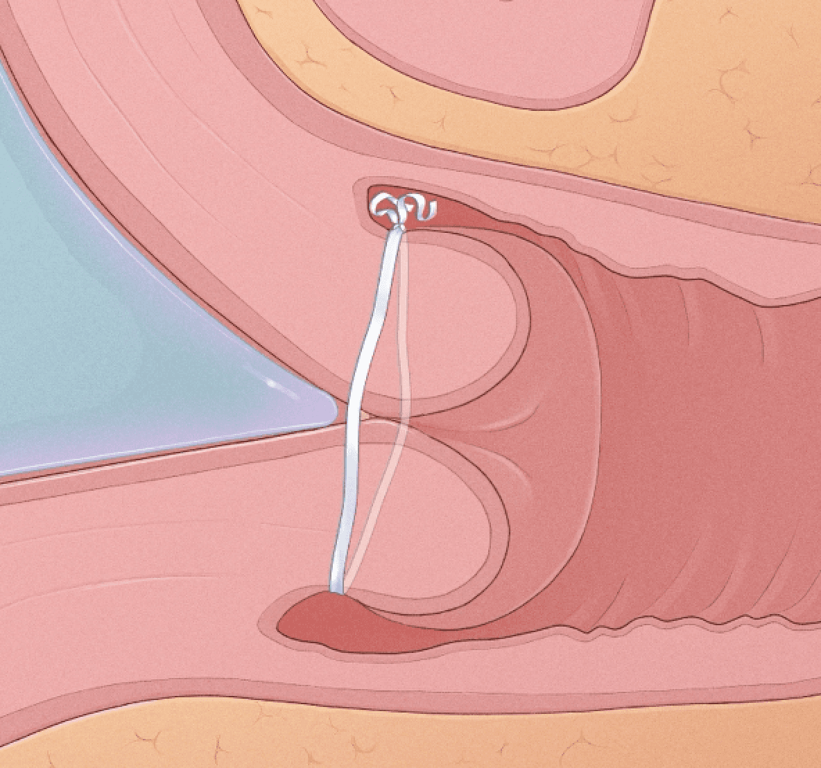 A cervix held closed by cerclage