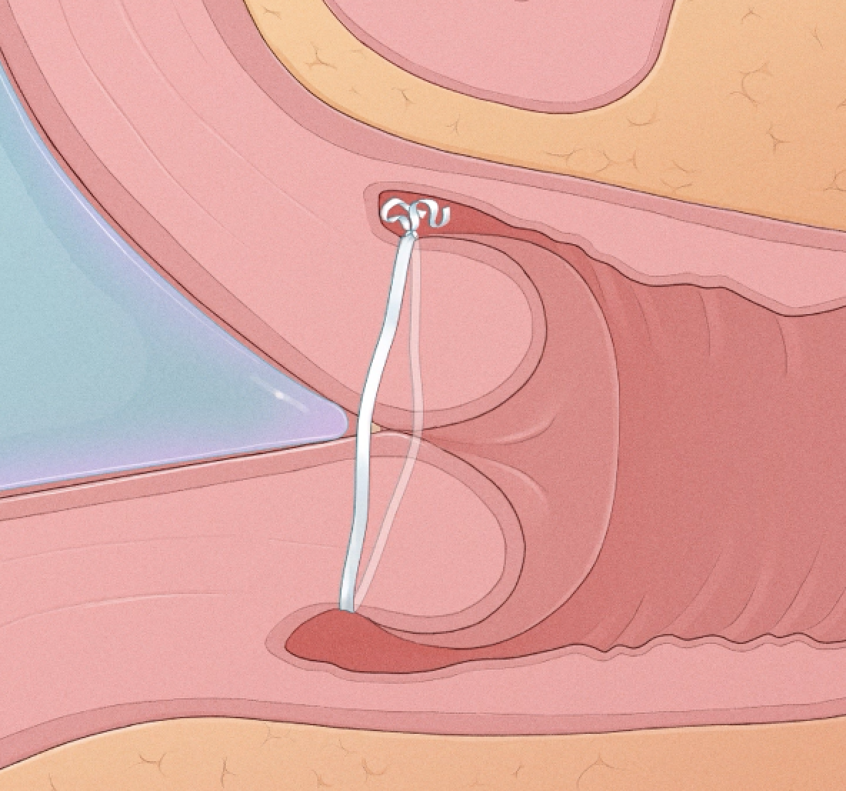 A cervix held closed by cerclage